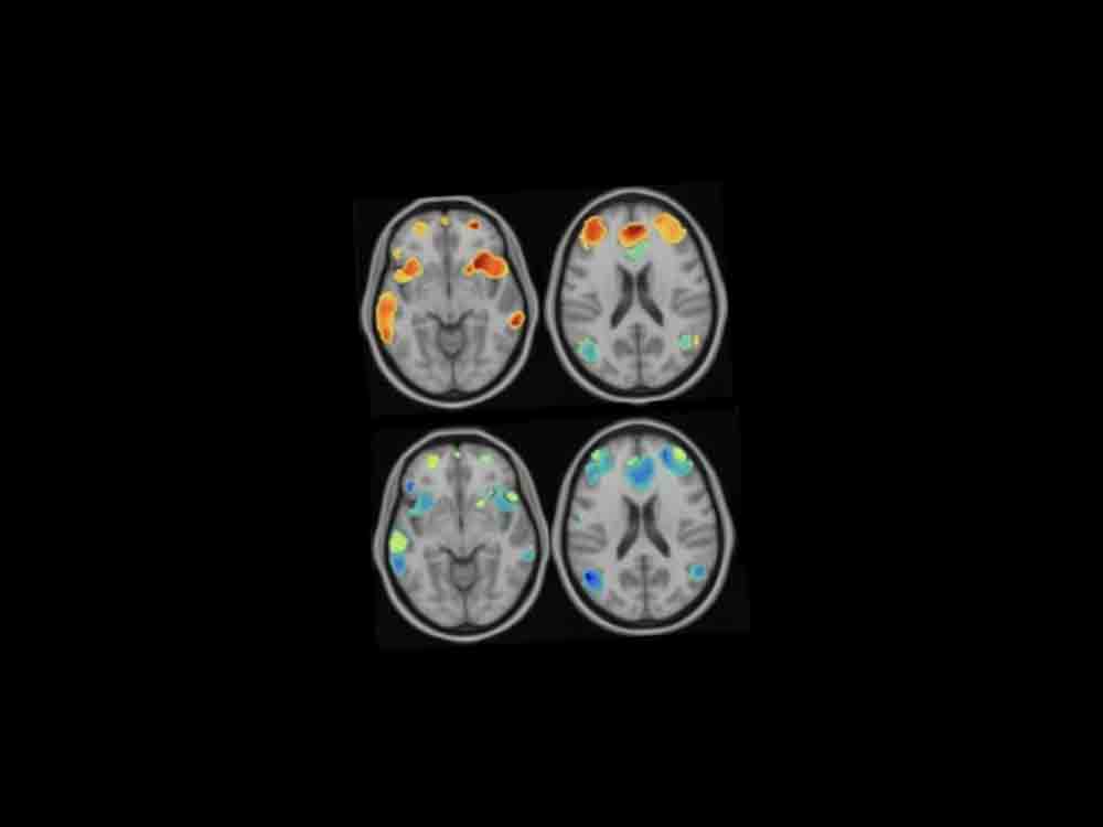 Magnetfeld gegen fehlgeleitete Hirnsignale, Forscher der Stanford University lüften Geheimnis um effektive Therapie gegen Depressionen Magnetfeld gegen fehlgeleitete Hirnsignale, Forscher der Stanford University lüften Geheimnis um effektive Therapie gegen Depressionen