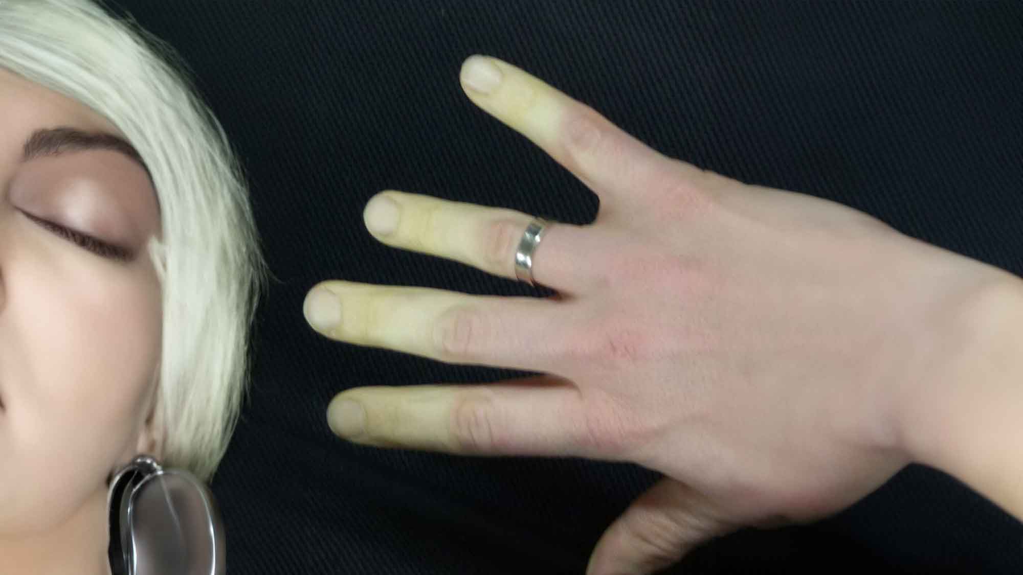 Raynaud Phänomen: Wenn Finger die Farbe verändern